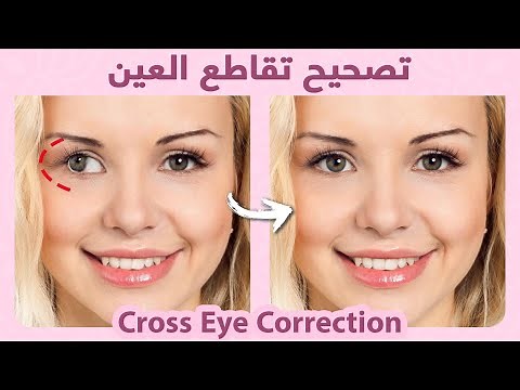 Best 3 exercises to fix Crossed Eyes at home (Strabismus) | أفضل 3 تمارين لإصلاح الحول في المنزل
