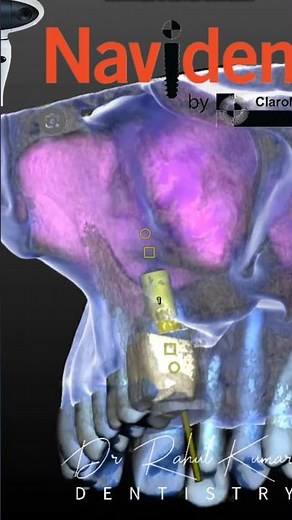 ROBOTIC GUIDED INDIRECT SINUS LIFT USING NAVIDENT