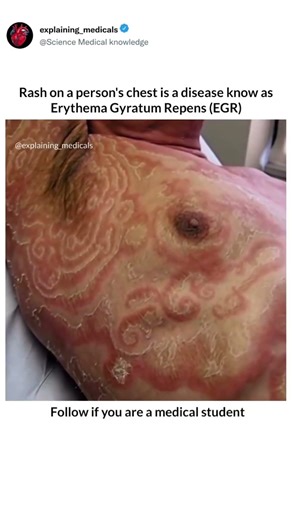 Rash on a person's chest is a disease know asErythema Gyratum Repens (EGR).