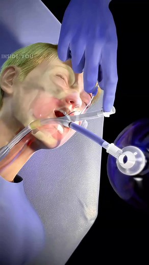 Endotracheal Intubation: A Life-Saving Procedure