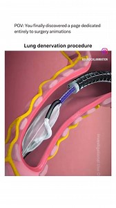 Lung Denervation Procedure Animation | Medical Talks