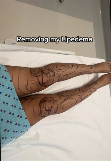 Managing Lipedema: My Journey and Workout Plan