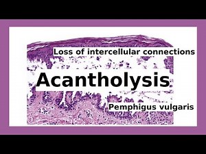acantholysis