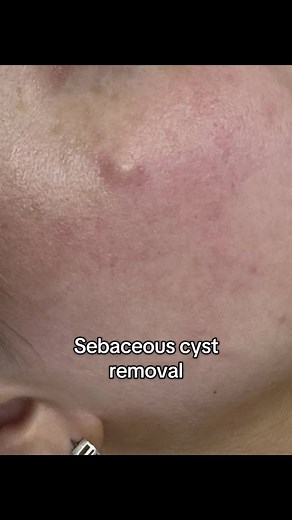 Sebaceous Cyst Removal at Ossett Laser Clinic