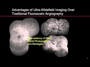 Ultra-Widefield Fluorescein Angiography in the Management of Diabetic Retinopathy