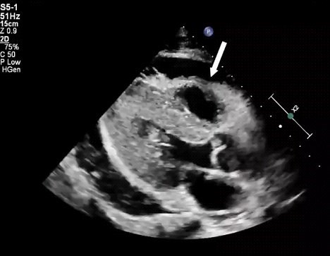 Cardiac tamponade. Note diastolic collapse of the right ventricle. Source: https://www.cvcasejournal.com/article/S2468-6441(22)00114-1/fulltext Great share @nephropocus #MedEd #medicalstudent #medicine #FOAMed #cardiology #nephrology #internalmedicine #internalmedicineresidency #criticalcaremedicine #echocardiography #sonographer #heartattack #heartdisease #heartdiseaseawareness | CardioVisual