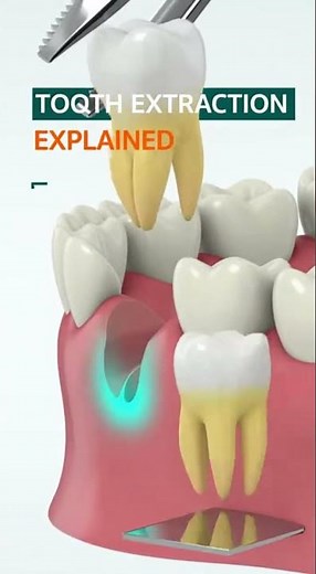 🦷 What Does “Tooth Extraction” Actually Mean?