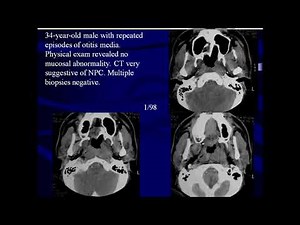 Imaging of nasopharynx