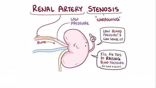 Video: Renal artery stenosis - Video Explanation! | Osmosis | Osmosis