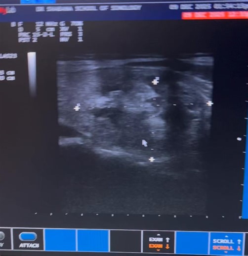 Differential diagnosis -Benign thyroid adenoma -Complex nodule in multinodular goiter -Degenerating/hemorrhagic nodule -Papillary carcinoma (especially if microcalcifications or irregular margins) -Follicular neoplasm (if rich vascularity solid component) | Dr. Shabana's School of Sonology.