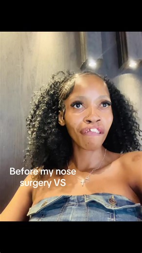 Nose Surgery: Before and After Transformation