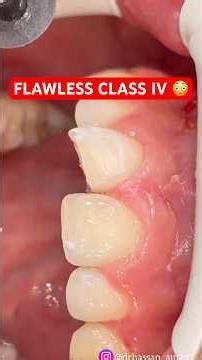 Broken Front Tooth? Watch This Class IV Composite Transformation 😳