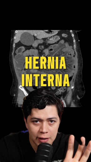 Dr. Jonah Serrano | Radiología on Instagram: "¿Sabías que tras un bypass gástrico puedes desarrollar una complicación llamada hernia interna? 🔹 Estas ocurren cuando asas del intestino se deslizan a través de defectos creados en el mesenterio o mesocolon durante la cirugía. 🔹 Son más frecuentes después de bypass gástrico laparoscópico, con una incidencia reportada de 0.2–9%. 🔹 Los tres tipos principales son: 👉 Transmesocólica 🌀 (a través del defecto en mesocolon transverso) 👉 Hernia en mese