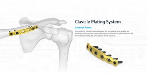 Distal Clavicle Fractures, AC and CC Joint Repair