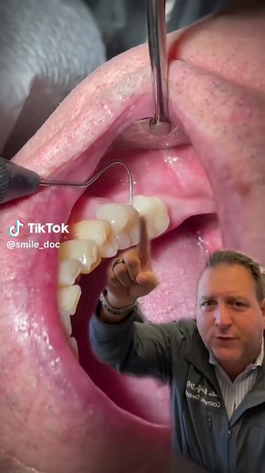Dental Crown Replacement Process Explained