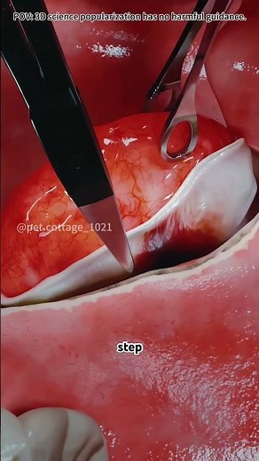 Tonsillectomy procedure #lofi #doctor #3danimation #science