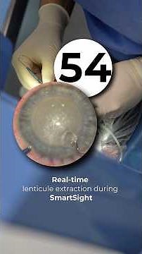 How SmartSight Works: The Role of the Surgeon in Lenticule Extraction #augenlasern