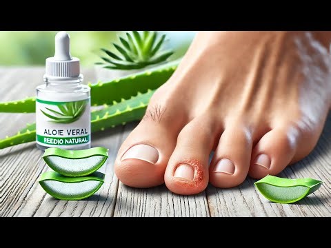 Remedio Natural con Sábila para Eliminar Hongos de las Uñas de los Pies