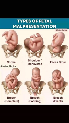 world_of_medico on Instagram: "Types of fetal mal presentation"