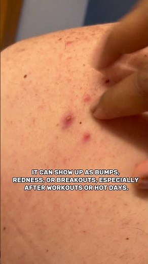 Why Do People Get Back Acne?