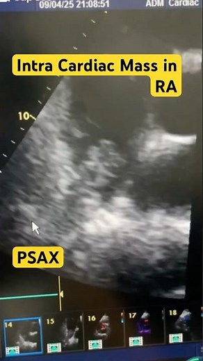 Intra Cardiac Mass in RA || Clot in RA