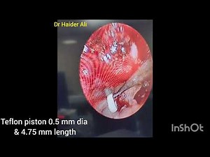 Endoscopic Stapedectomy with Teflon piston placement