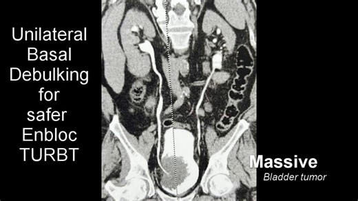 🔥 Giant vascular bladder tumor?What if En bloc resection of bladder tumor feels unsafe (bleeding ⚠️ / perforation risk)?⚡️ Start smart: Feeder vessel coagulation to control inflow⚡️ Then: Unilateral debulking to improve vision & reduce bulk👉 Once you clearly expose the base…Proceed to En bloc resection with confidence 💪