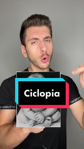Ciclopia: Un'Anomalia Congenita Rara