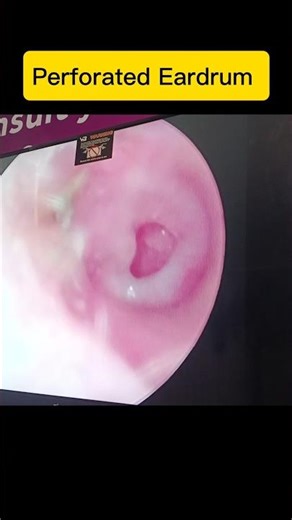 Perforated Eardrum #asmr #eardoctor #entdoctor #ear wax