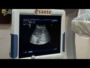 Ptbd and biliary stenting using advanced interventional techniques