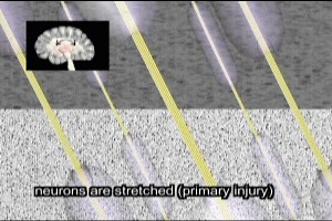 Diffuse Axonal Injury Video - Trial Image Inc.
