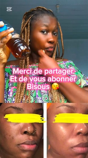 Astuces pour éliminer les boutons sur ton visage. https://www.instagram.com/rita_elisa_bio?igsh=cnppdGNlbHQyejdn&utm_source=qr . Insta | Rita Elisa Bio