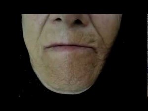Jaw tremor of Parkinson's disease.Osama SM Amin FACP