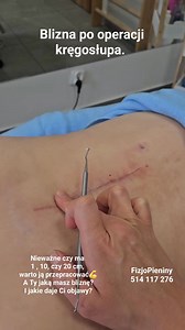 Blizna po operacji kręgosłupa 🔪 To moze byc też inna blizna: po operajcji serca, pluca, biodra, kolana, złamanej piszczeli, czy po porodzie CC... Nieważne czy ma 1cm, bo w tym miejscu był dren, czy 20cm, bo operacja była wielopoziomowa. Warto przepracować bliznę, aby objawy mrowienia, ciągnięcia, ograniczenia ruchomości zniwelować i funkcjonować najbardziej możliwie bez bólu. A Ty jaką masz bliznę? 😉 Bo ja nad swoimi pracuje często 💪 FizjoPieniny 514 117 276 | FizjoPieniny