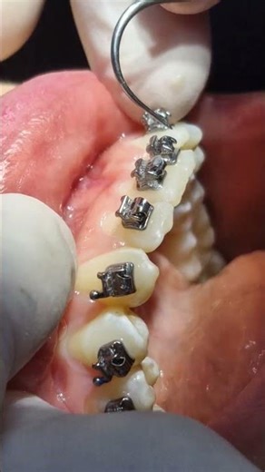 Brackets sin ligas ✨