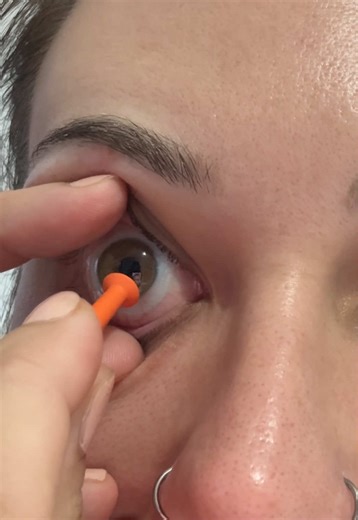 Suctioning My Eyeball for Keratoconus Relief