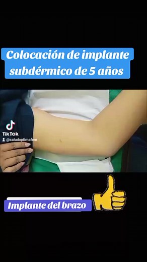 Colocación de implante subdérmico de 5 años
