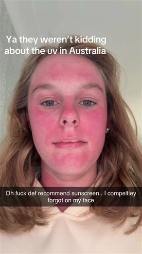 I did in fact put sunscreen on and this happened in the span of 2 hours at the beach. #burn #sun #australia #beach #s