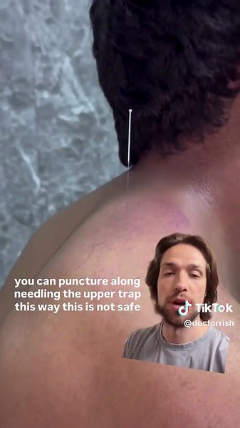Insane. Don’t do this. Don’t let anyone do this to you | dry needling