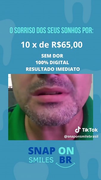 Somente aqui na Snap On Smiles Brasil você consegue o sorriso dos sonhos de forma 100% digital. #snaponsmile