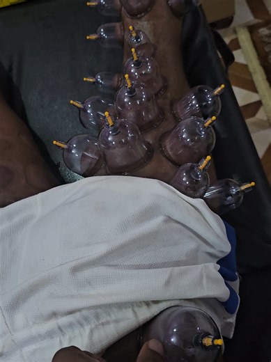 sciatic nerve ,miguu kuvimba , ganzi , miguu kuwaka moto basi njoo nikutibie biidhillah ytapona #viral_video #detoxhijama #drempire #fullbodycuppingtherapy #fypage