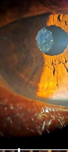 YAG Laser capsulotomy for secondary cataracts || #ophthalmology #ophthalmic #optometry