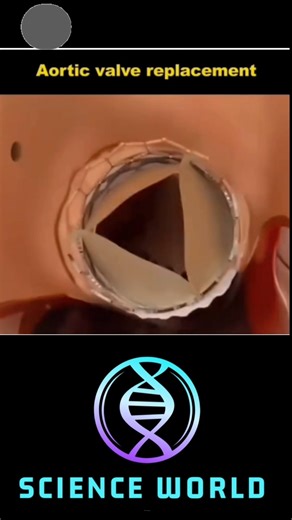 Aortic valve replacement #sciencefacts #science #medical