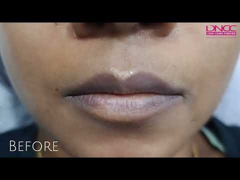 Lip Microblading Procedure Step by Step | Before & After Lip Microblading Results | DNCC