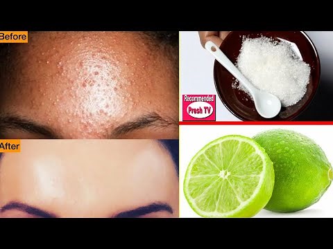 How To Remove Pimples Overnight । Acne Treatment । Remove Pimples Overnight with Lemon (clear skin)