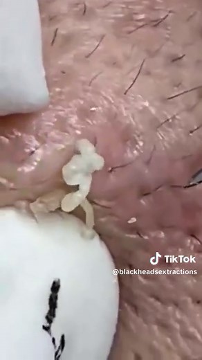 Effective Blackheads Removal Techniques at Spa Skin Care