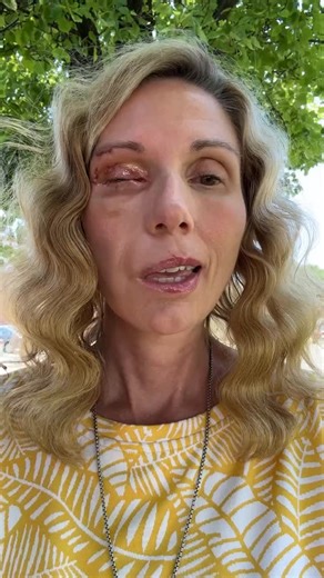 Jodi Orgill Brown on Instagram: "Today, I did something that felt small… but was actually huge. After my 25th surgery, I stepped back into the world—blind and paralyzed on one side, and more visible than I’d like. But I showed up anyway. Not because I’m fully healed. But because healing IS the showing up. And today, I started building a new normal. --> If you’re navigating change, pain, or uncertainty—this video is for you. You don’t have to go back to how things were. You can become something e