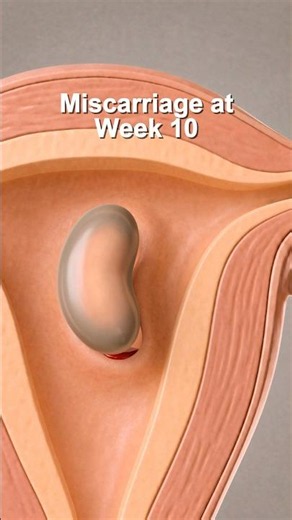Miscarriage at Week 10 Explained