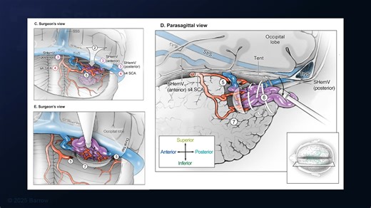 #488: Torcular Craniotomy for Resection of a Tentorial Cerebellar Arteriovenous Malformation - All Videos - Seven Series Collection