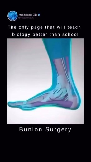 Medical | Science | Life on Instagram: "🌟 Say goodbye to foot pain! 🦶 Discover how bunion surgery can realign your foot and improve your comfort. From pre-op to post-op, we’re taking you through the process. Watch to learn about the benefits and recovery tips! #BunionSurgery #FootHealth #OrthopedicCare #3danimation #reels #viral #explore #science #biology"